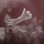 baby-gives-thumbs-ultrasound
